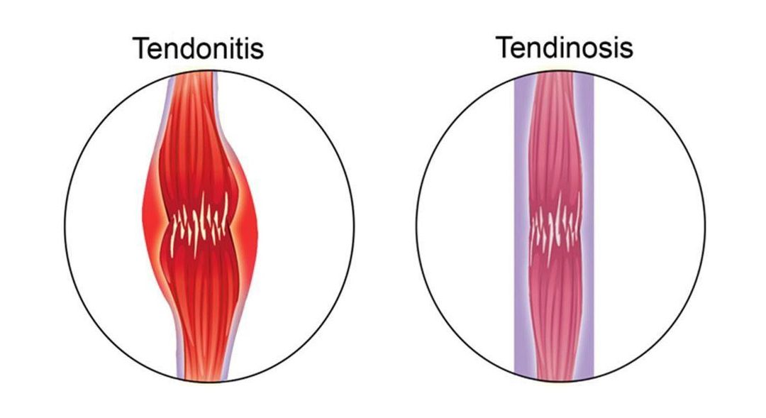 Tendinosis Versus Tendinitis